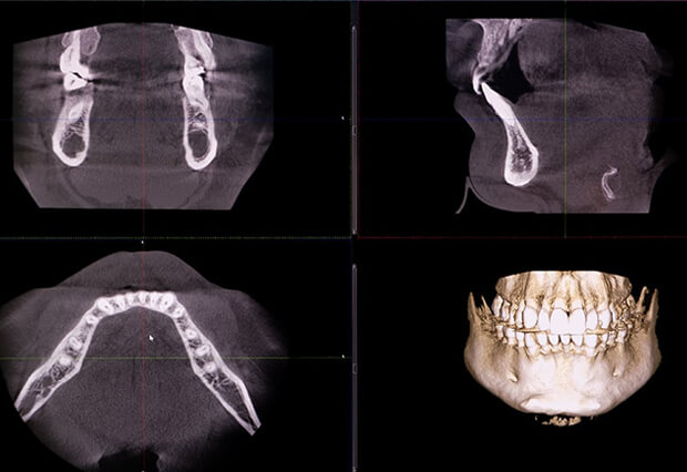 歯科用CT