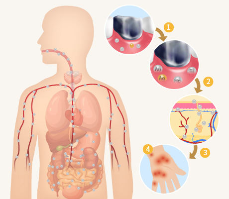 金属アレルギーの仕組み