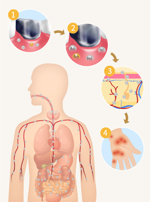 歯科金属アレルギーの仕組図｜金属アレルギー・掌蹠膿疱症専門歯科医療サイト｜愛媛県松山市もりもと歯科クリニック