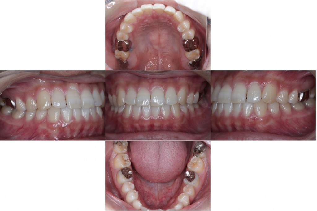 保険診療と自費診療を組み合わせたメタルフリー治療｜治療前の全体像｜金属アレルギー・掌蹠膿疱症専門歯科医療サイト｜もりもと歯科クリニック