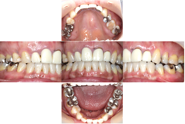 森本歯科クリニック｜症例｜保険診療と自費診療を組み合わせたメタルフリー治療｜治療前の歯の画像