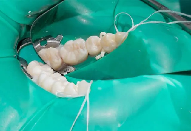 ラバーダムによる治療の画像｜銀歯の方は要注意　水銀を含む「アマルガム」とは｜もりもと歯科クリニック