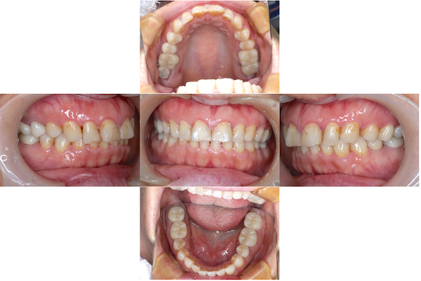 【症例】オールセラミックを使用したメタルフリー治療