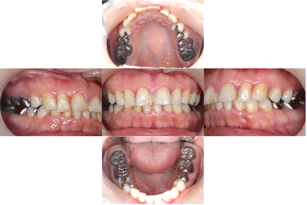 松山 もりもと歯科｜ブログ｜【症例】オールセラミックを使用したメタルフリー治療｜治療前の歯の画像