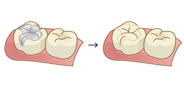 愛媛県松山市の歯医者もりもと歯科クリニック｜ブログ｜2023年12月〜保険適用が拡大！メタルフリーの「CAD/CAM冠」｜銀歯とCAD/CAM冠を入れた歯のイメージ画像