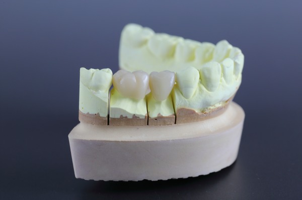 2026年6月 診療報酬改定｜CAD/CAM冠・インレーの適応範囲が大きく広がります