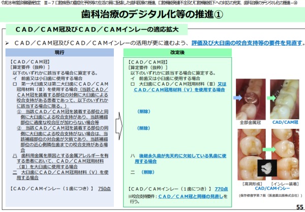 厚生労働省保険局医療課「令和８年度診療報酬改定の概要 【歯科】」｜2026年6月 診療報酬改定｜CAD/CAM冠・インレーの適応範囲が大きく広がります｜金属アレルギー・掌蹠膿疱症専門歯科医療サイト｜愛媛県松山市もりもと歯科クリニック