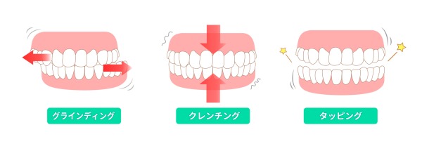 歯ぎしり・食いしばりの3タイプ｜歯ぎしり・食いしばりの原因と影響｜リスクと対策を解説｜金属アレルギー・掌蹠膿疱症専門歯科医療サイト｜愛媛県松山市もりもと歯科クリニック