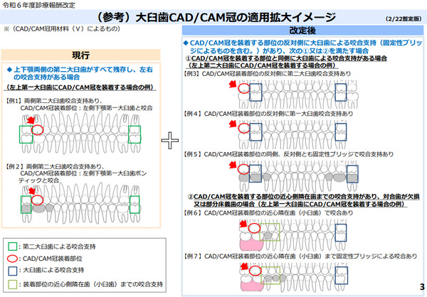 CAD/CAMブリッジ適用拡大のイメージ|CAD/CAMブリッジが2026年6月から保険適用に|メリットとデメリットを詳しく解説|金属アレルギー・掌蹠膿疱症専門歯科医療サイト|愛媛県松山市もりもと歯科クリニック